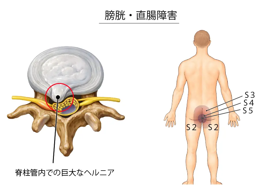 膀胱・直腸障害