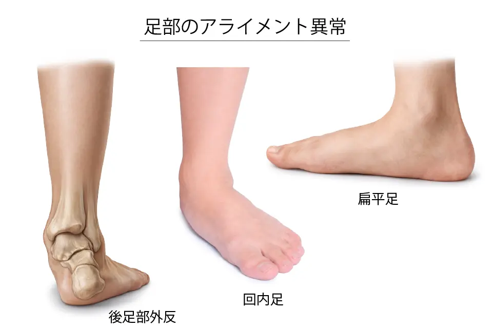 足部のアライメント異常