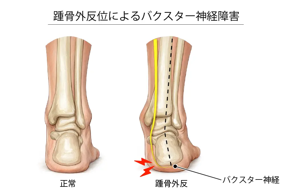 踵骨外反によるバクスター神経障害