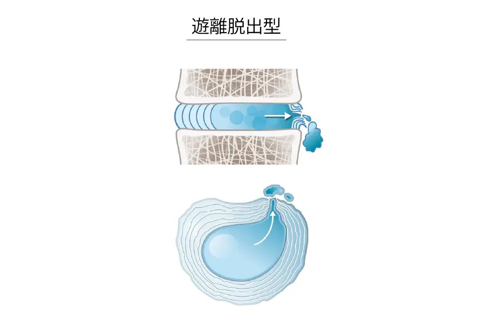 遊離脱出型