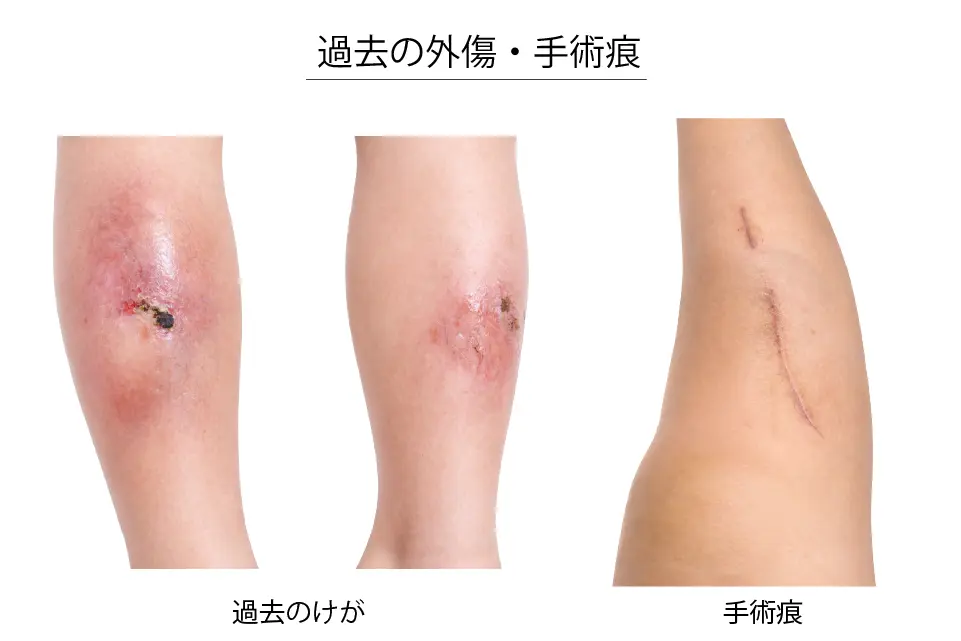 過去の外傷・手術痕