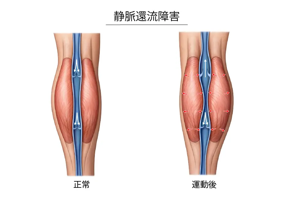 静脈還流障害