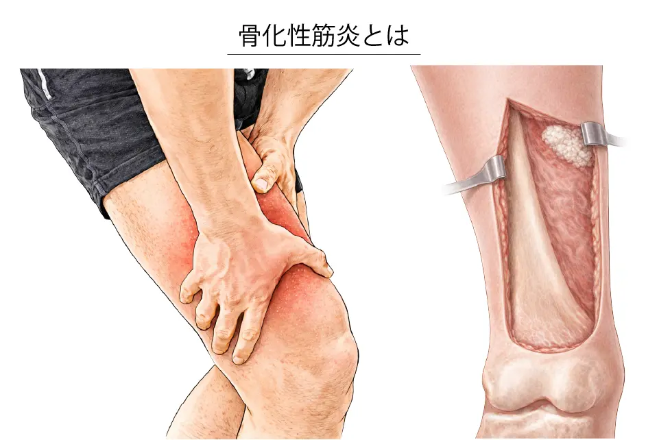 骨化性筋炎とは