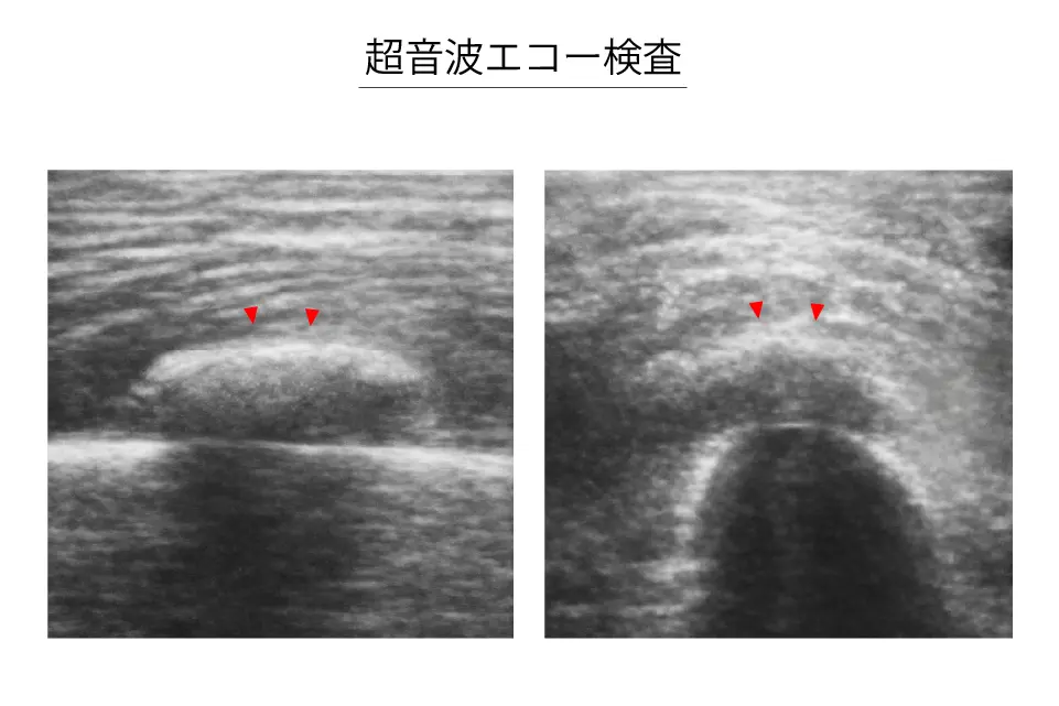 骨化性筋炎のエコー検査
