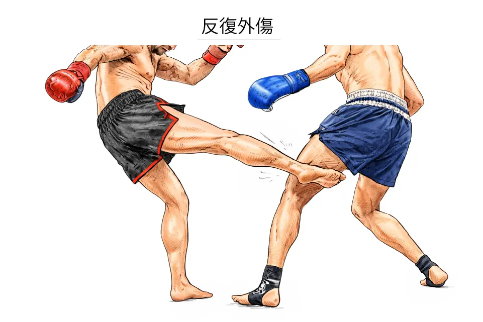 骨化性筋炎（反復外傷）