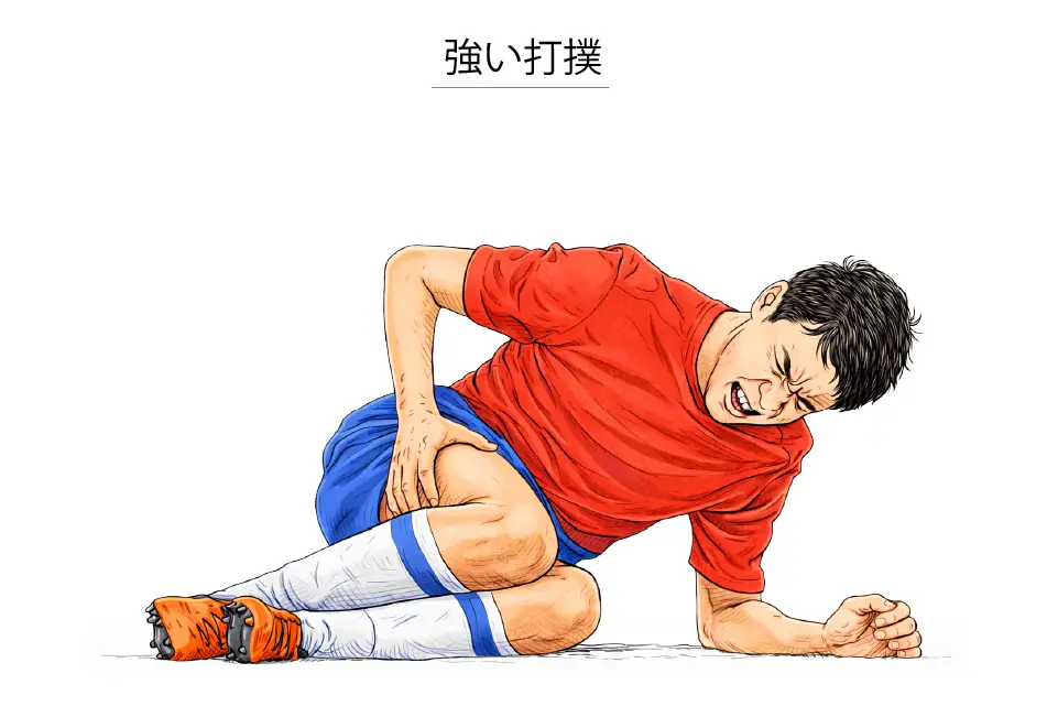 骨化性筋炎（強い打撲）