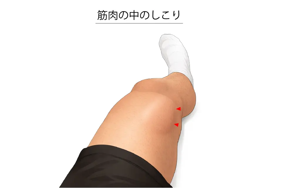 骨化性筋炎（筋肉の中のしこり）