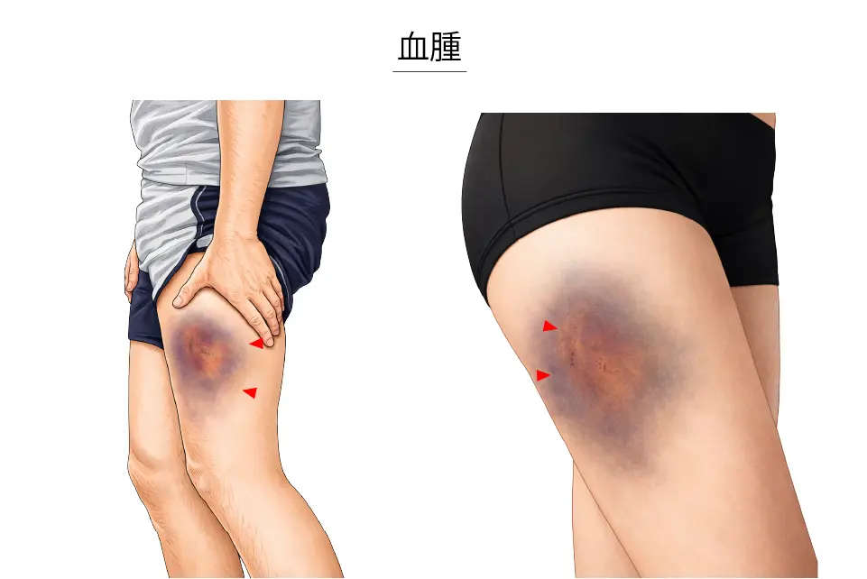 骨化性筋炎（血腫）