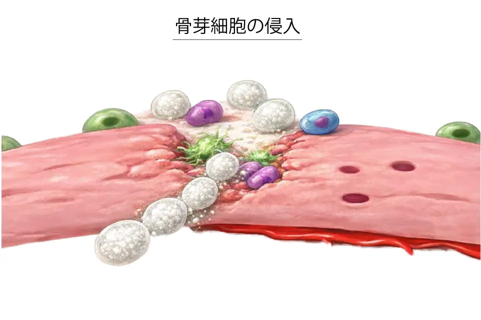 骨芽細胞の侵入