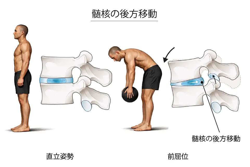 髄核の後方移動