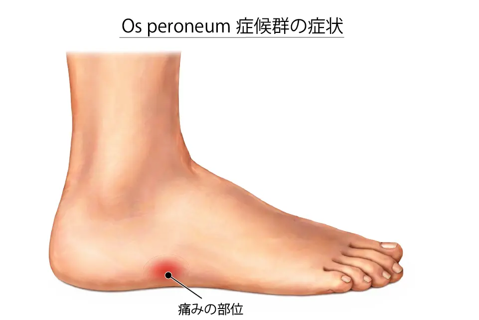 Os peroneum症候群とは (1)