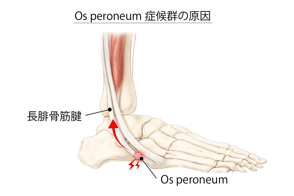 Os peroneum症候群の原因