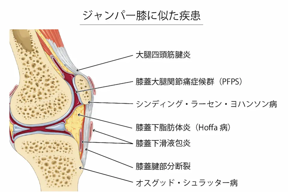 ジャンパー膝に似た疾患