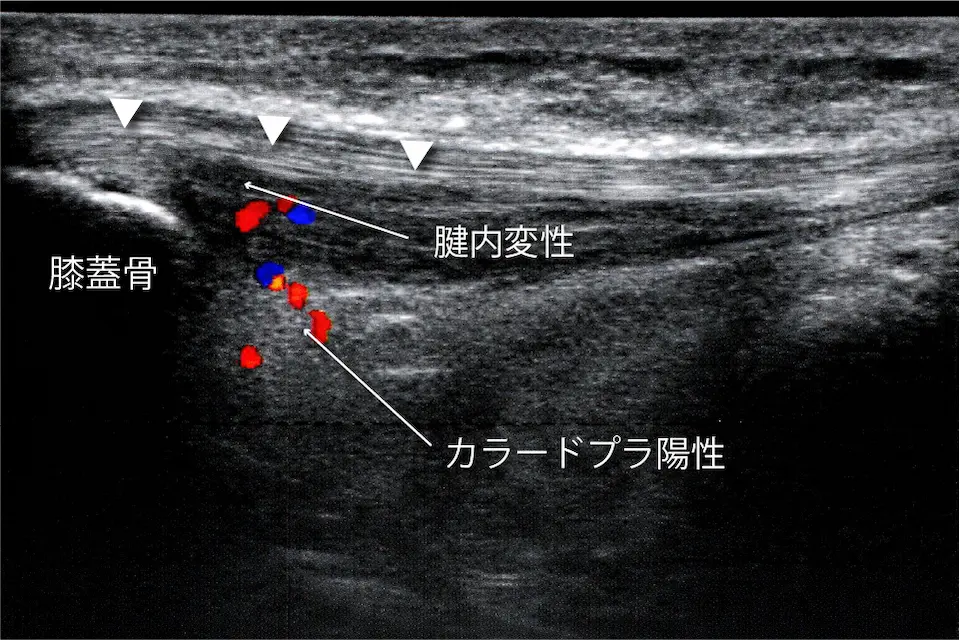 ジャンパー膝エコー慢性期