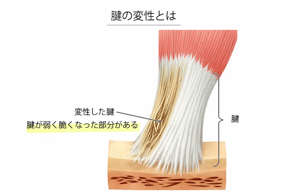 ジャンパー膝（腱の変性とは）
