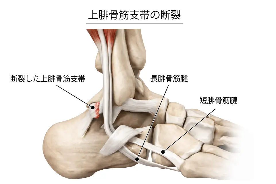上腓骨筋支帯の断裂