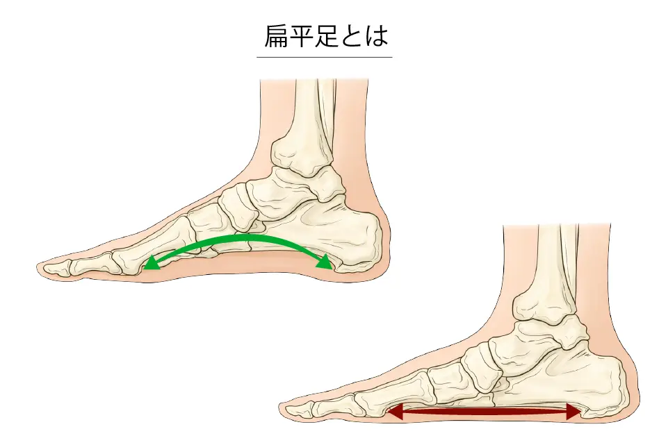 扁平足とは