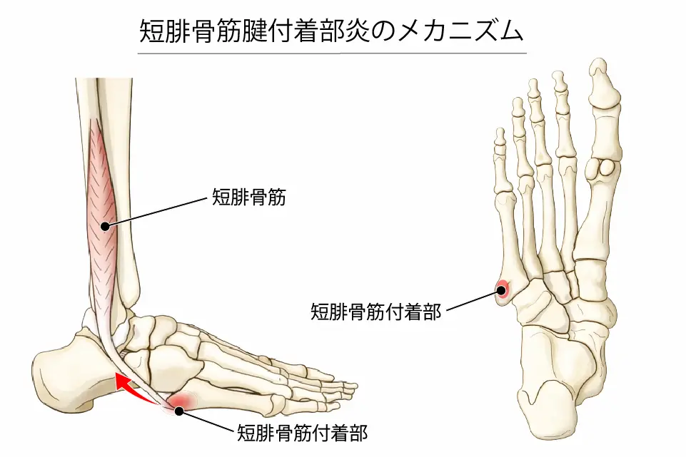 短腓骨筋腱付着部炎