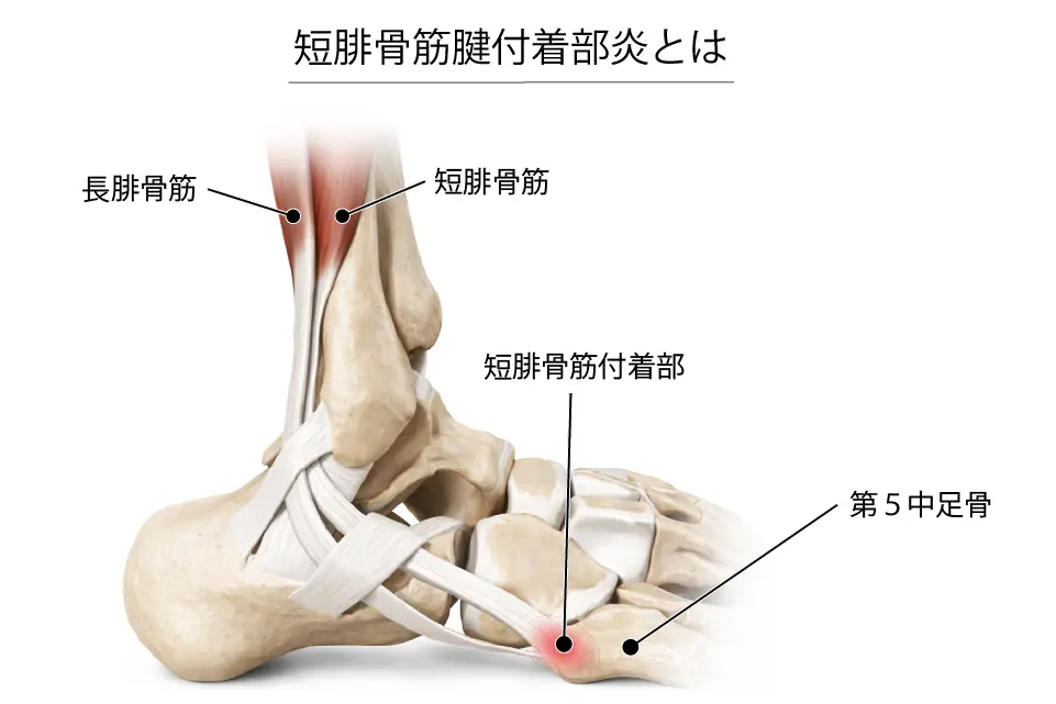 短腓骨筋腱付着部炎とは