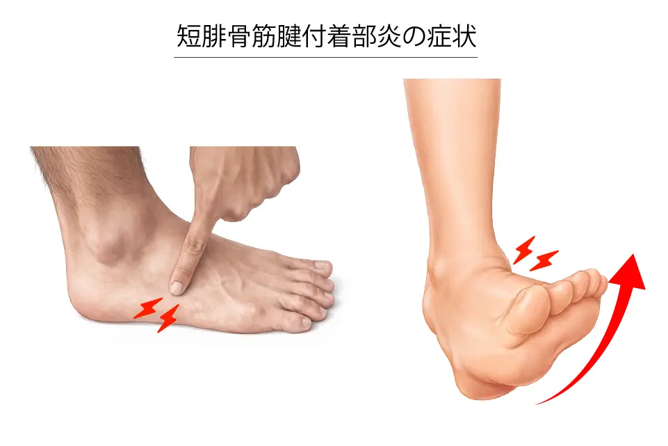 短腓骨筋腱付着部炎の症状