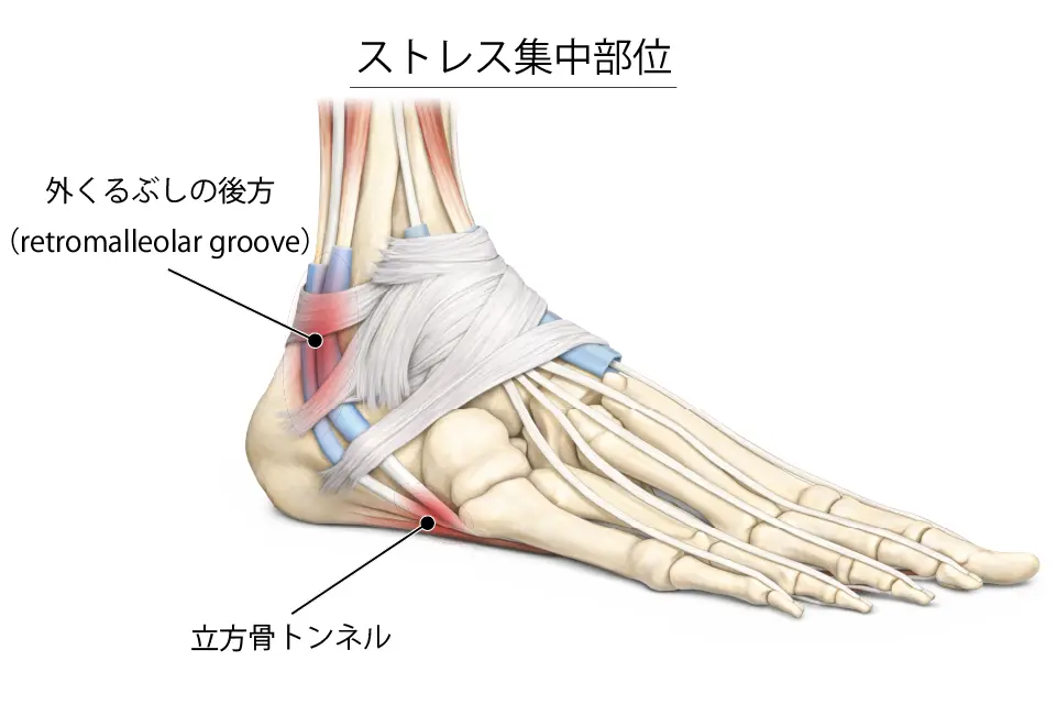 腓骨筋腱のストレス集中部位