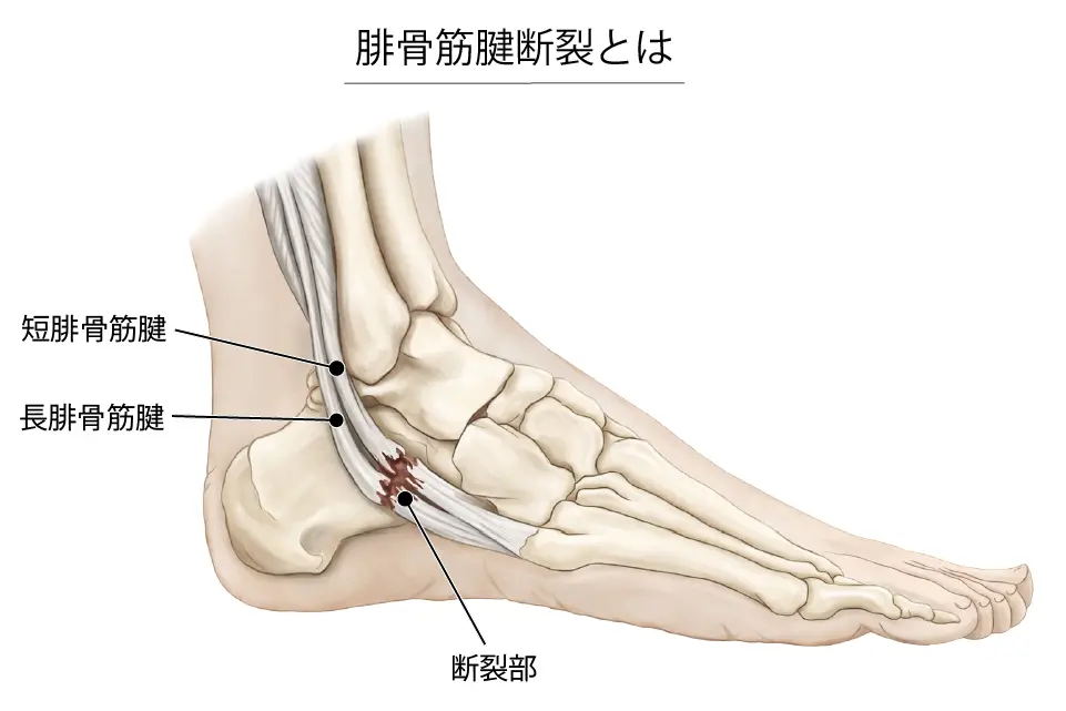 腓骨筋腱断裂とは