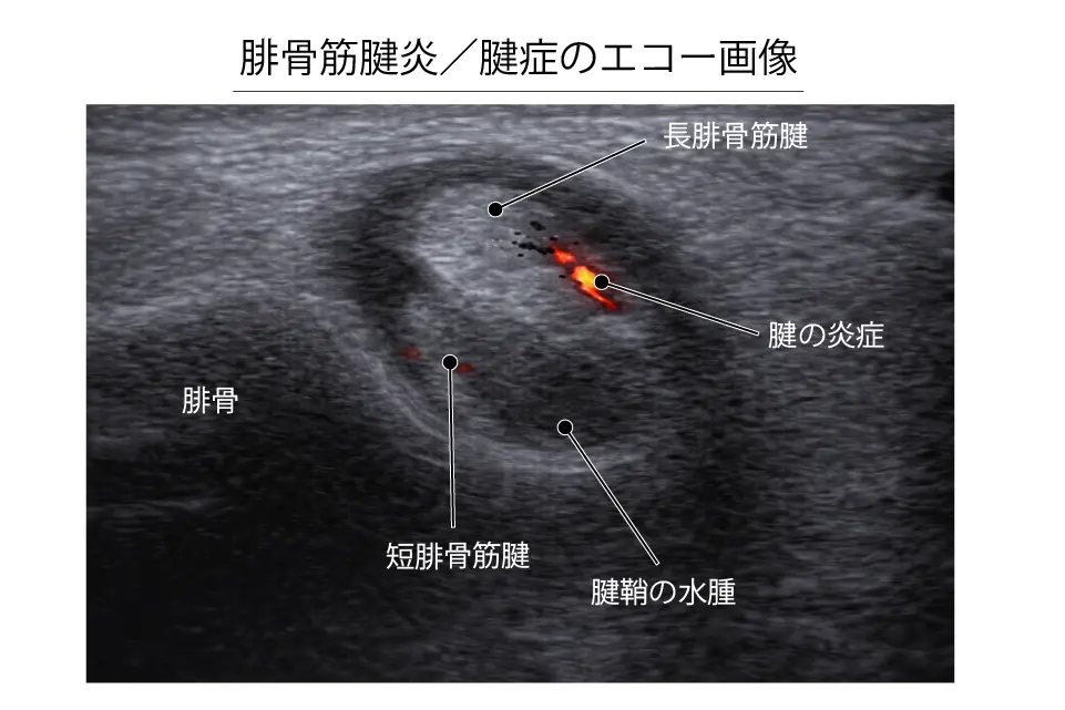 腓骨筋腱炎のエコー画像