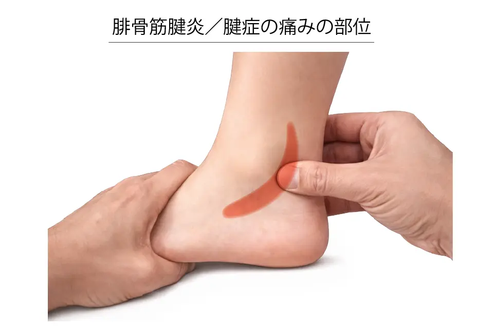 腓骨筋腱炎（痛みの部位部位）
