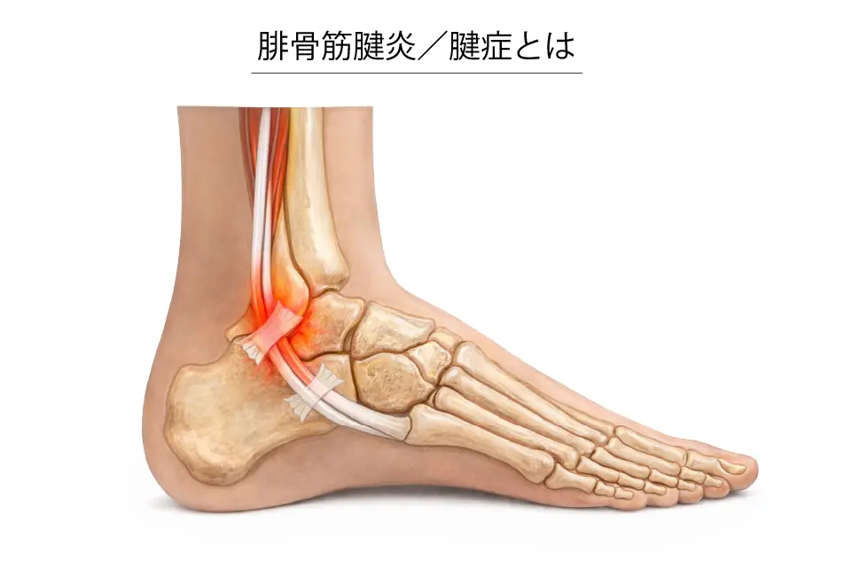 腓骨筋腱炎／腱症とは