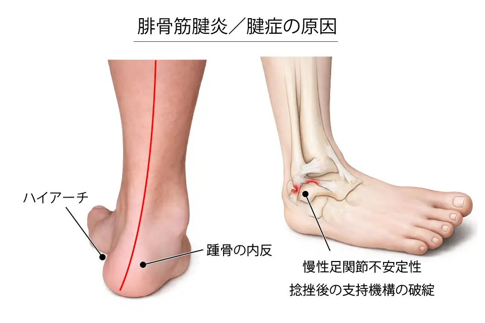 腓骨筋腱炎／腱症の原因