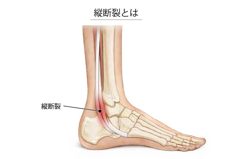 腓骨筋腱縦断裂とは