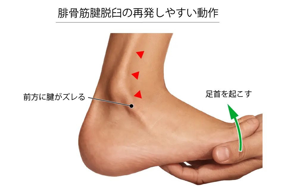 腓骨筋腱脱臼が再発しやすい動作