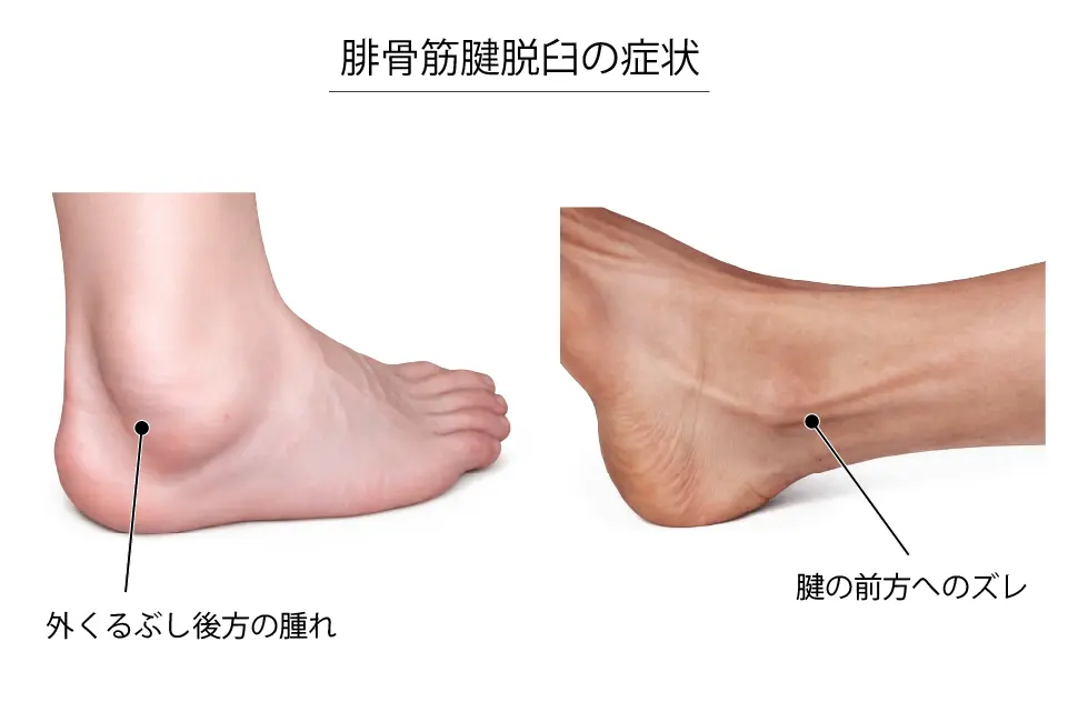腓骨筋腱脱臼の症状