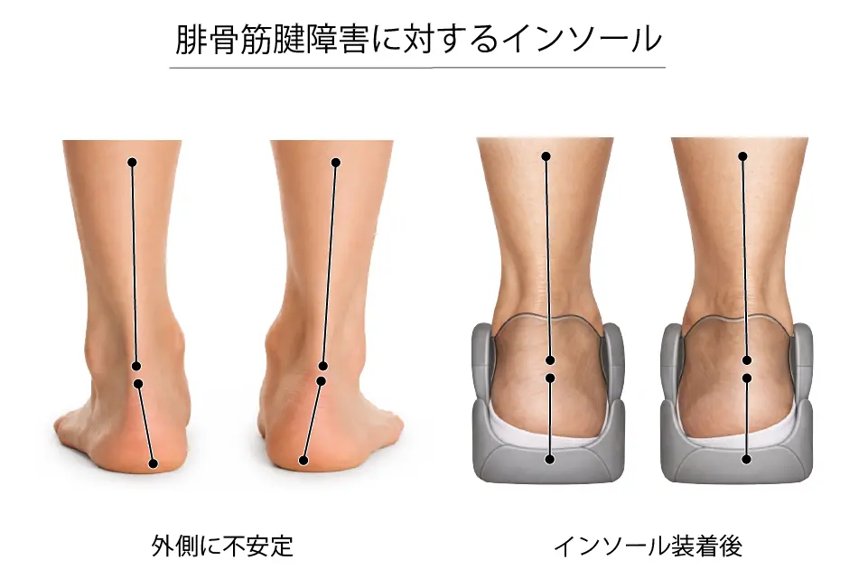腓骨筋腱障害に対するインソール