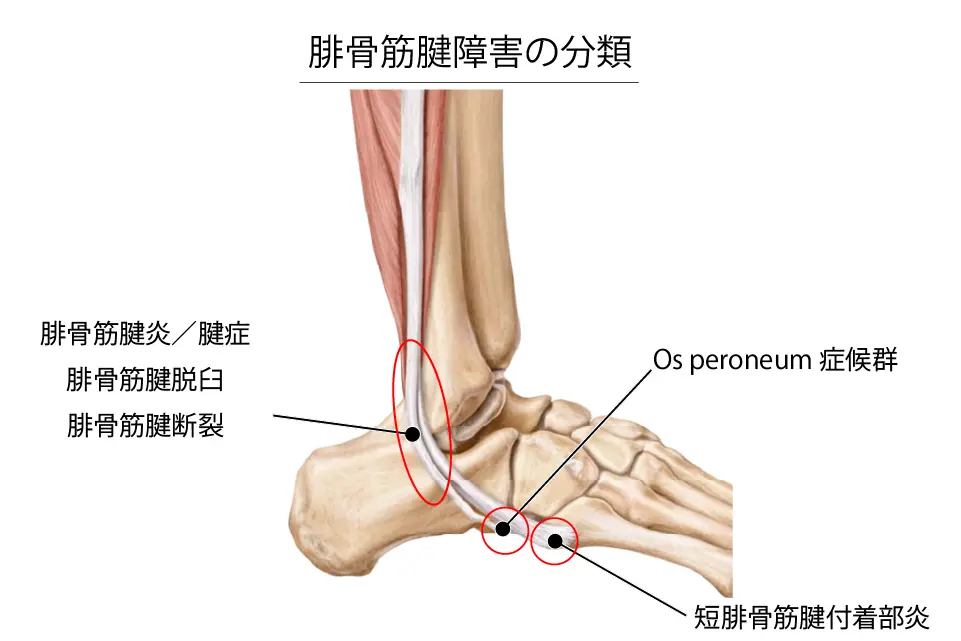 腓骨筋腱障害の分類