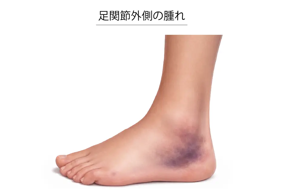 足関節外側の腫れ