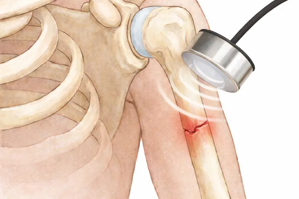 上腕骨の疲労骨折LIPUS