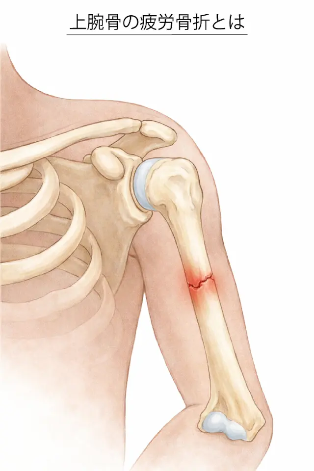 上腕骨の疲労骨折とは２