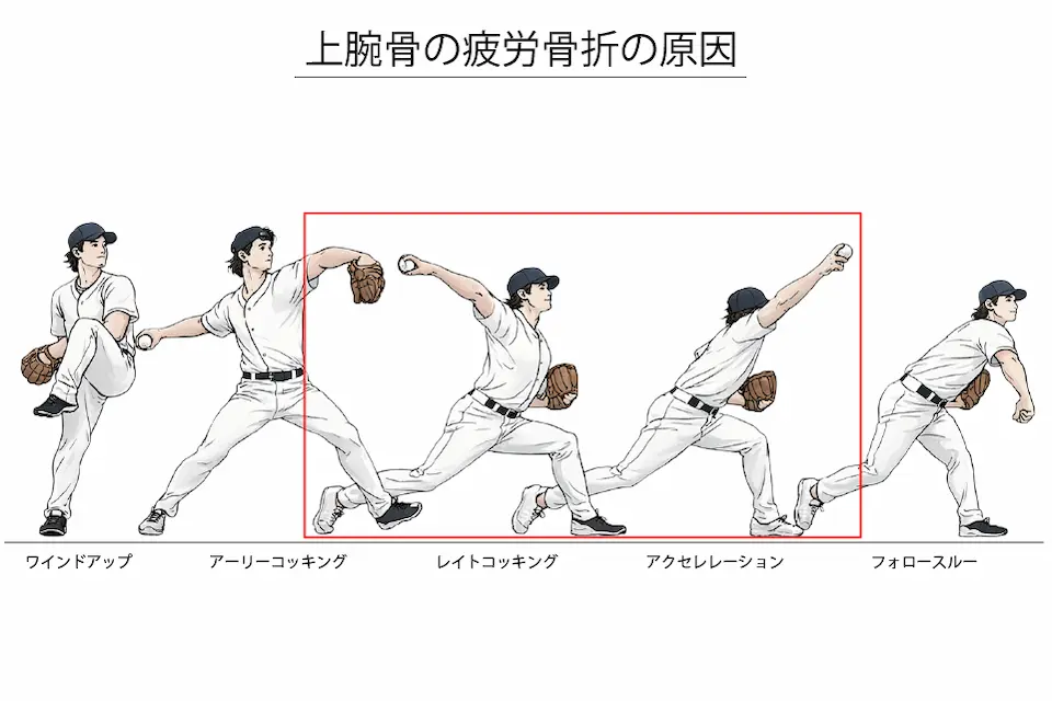 上腕骨の疲労骨折の原因