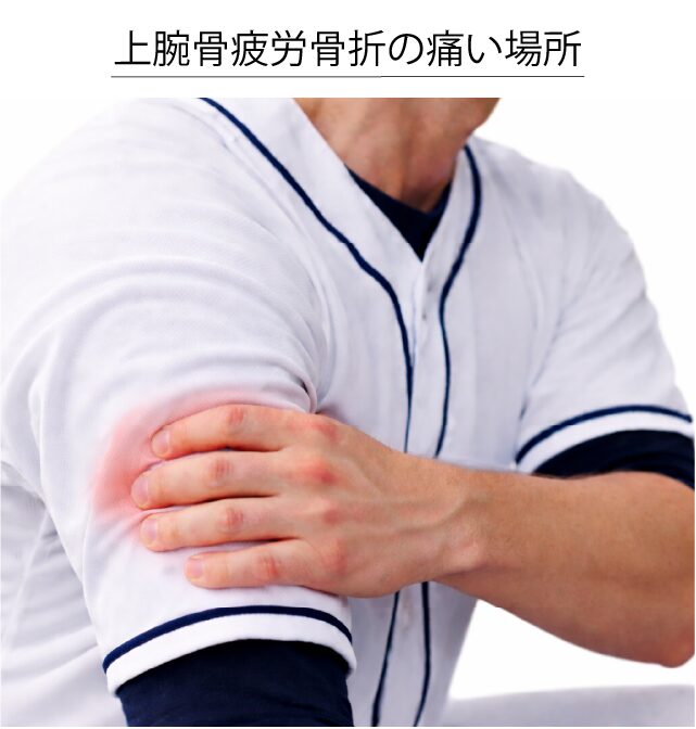 上腕骨の疲労骨折の痛い場所