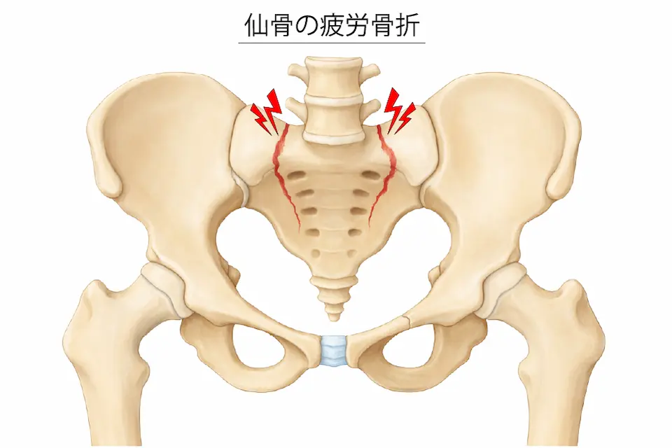 仙骨の疲労骨折