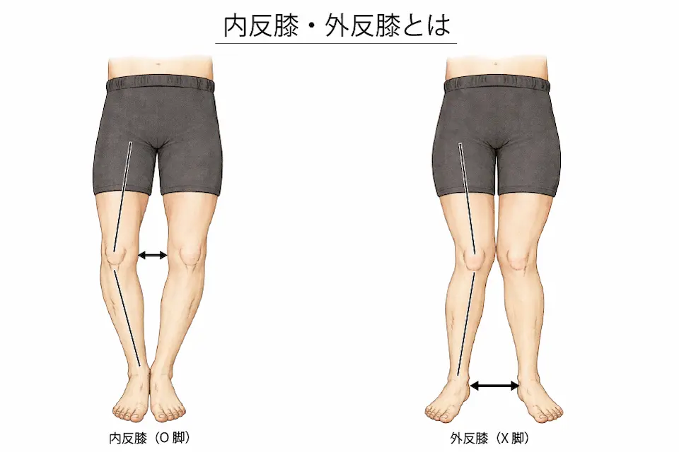 内反膝・外反膝