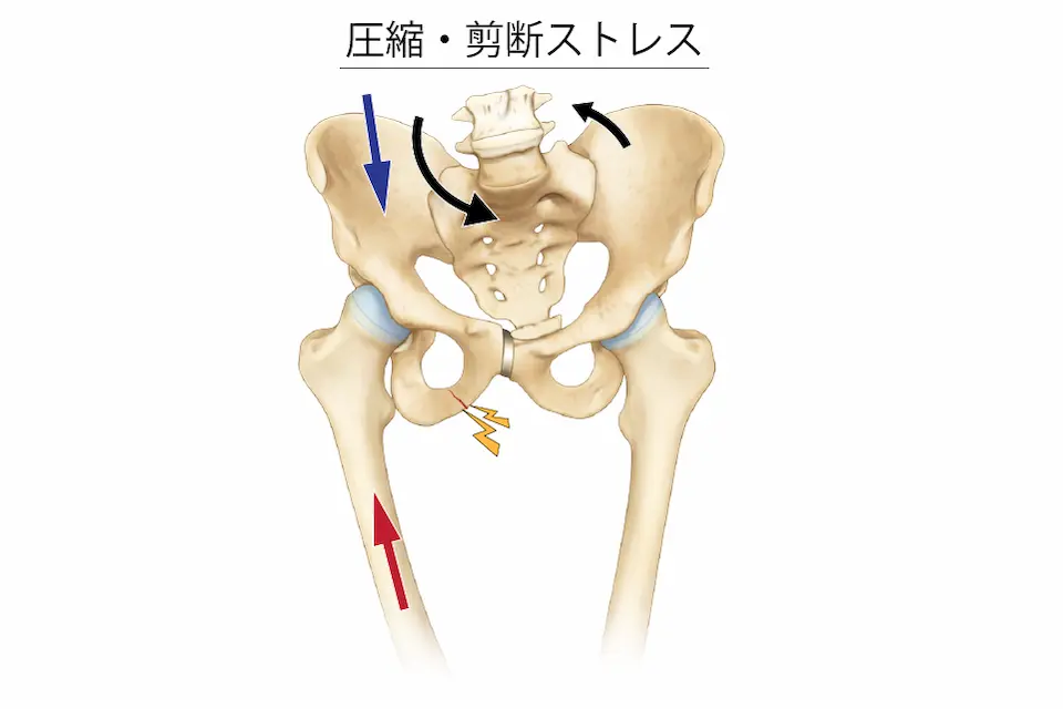 圧縮・剪断ストレス