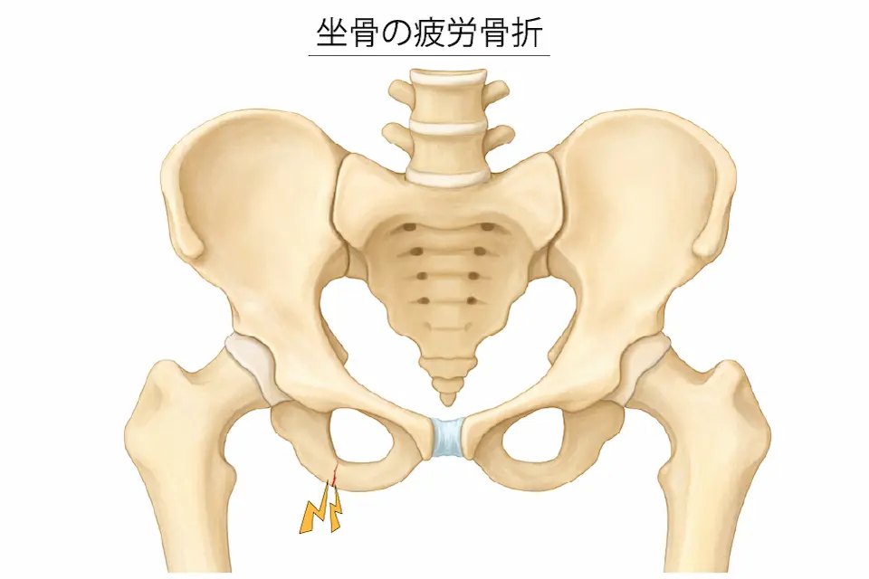 坐骨の疲労骨折