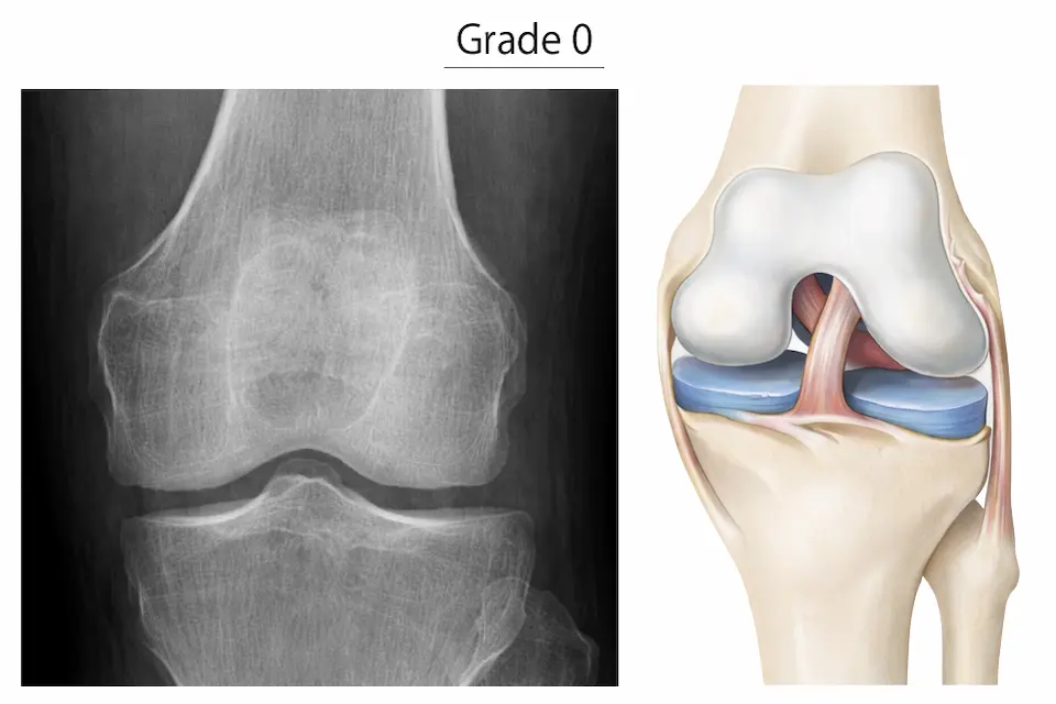 変形性膝関節症KL分類グレード0