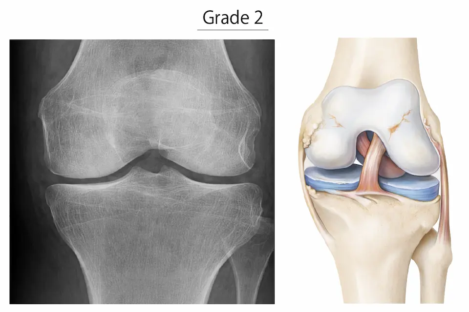 変形性膝関節症KL分類グレード2