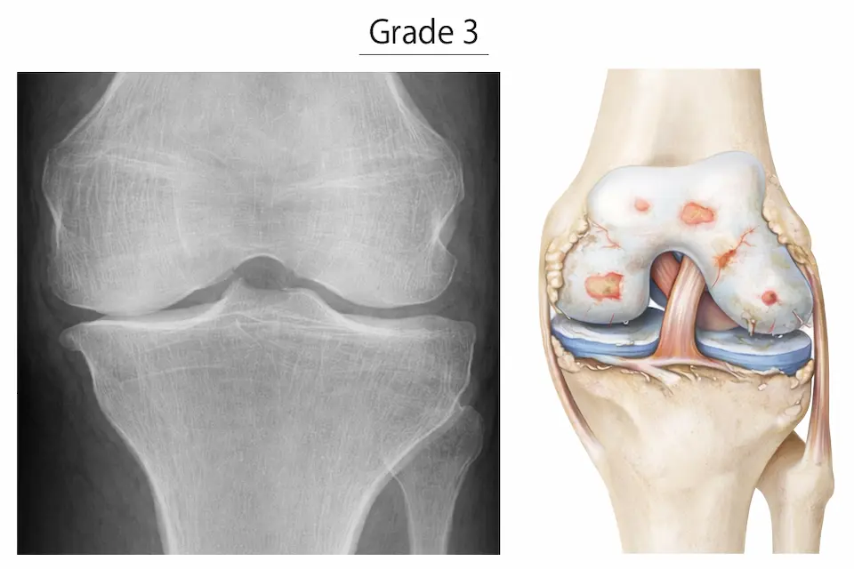 変形性膝関節症KL分類グレード3