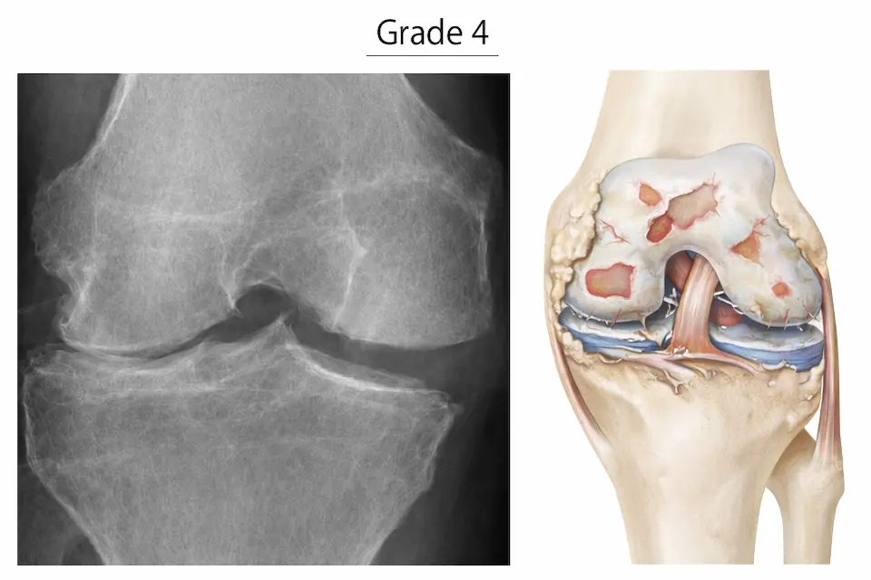 変形性膝関節症KL分類グレード4