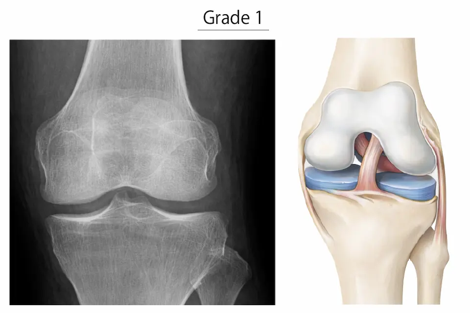 変形性膝関節症KL分類グレード１
