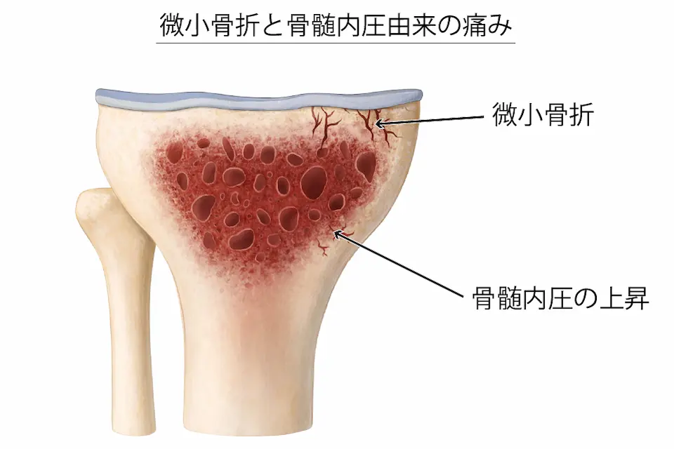 変形性膝関節症微小骨折
